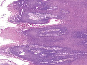 Focal epithelial hyperplasia
