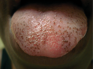 Pigmented papillae of the tongue