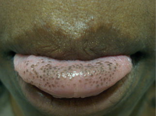 Papille pigmentate della lingua