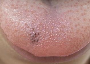 Pigmented papillae of the tongue