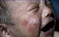 Neonatal cephalic pustulosis