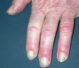 lupus pernio fingers
