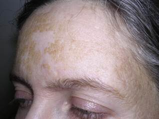 Dermatosis negletta