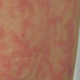 Hot water bottle warning: Dr Amir warns they can cause 'erythema