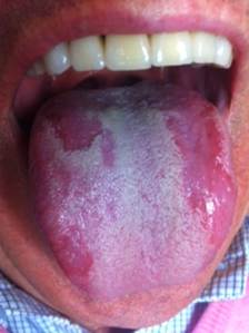 worst fissured tongue