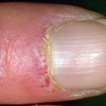 Changes in the nailfolds of the fingers