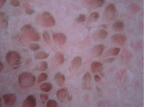 Pigmented papillae of the tongue